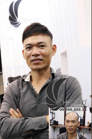 kiểu tóc cho nam hói 2 bên 2