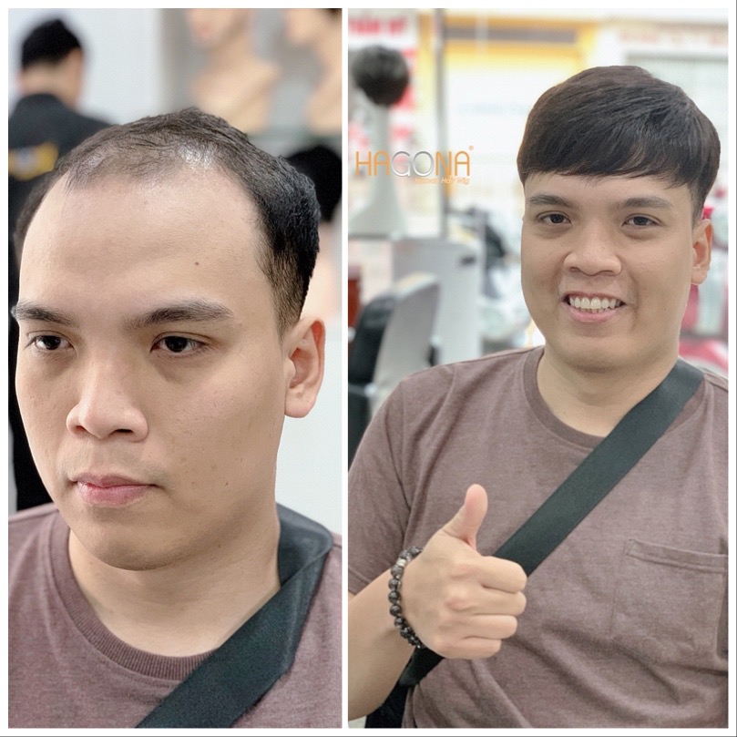 kiểu tóc cho người hói chữ m