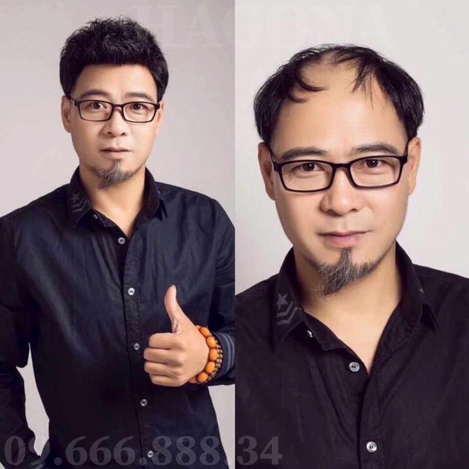 kiểu tóc nam dành cho người hói trán