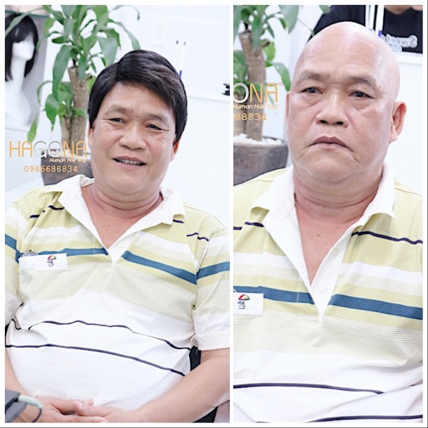 Tóc mái hói nam có da đầu