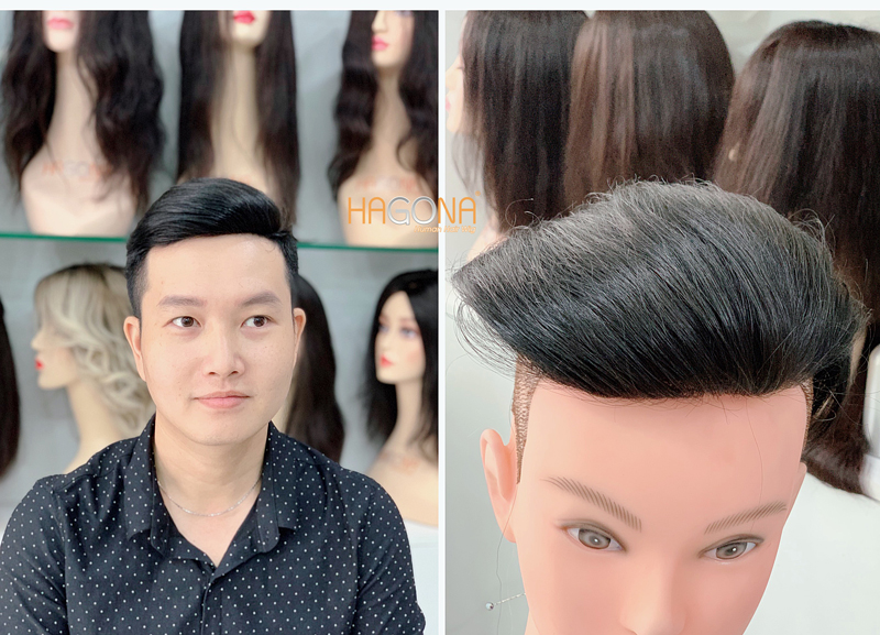 tóc mái hói nam chữ m