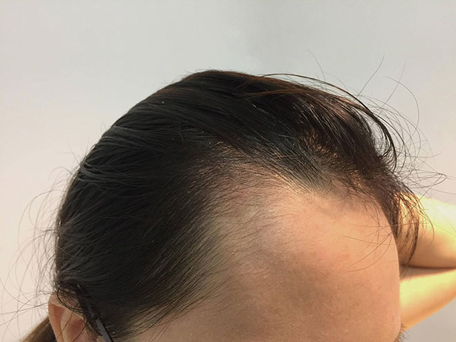 hiện tượng rụng tóc sau sinh