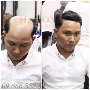 Mua tóc mái giả cho nam 2
