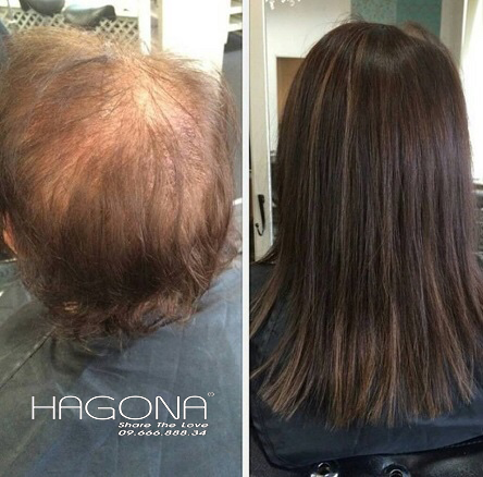 Mua tóc giả cho người bị ung thư