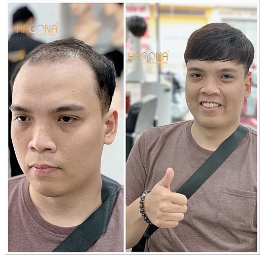 tóc giả mái hói