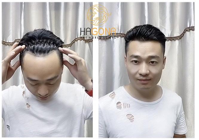 tóc giả nam cho người hói