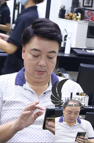 Những kiểu tóc cho nam hói 2 bên giá rẻ tại Hagona