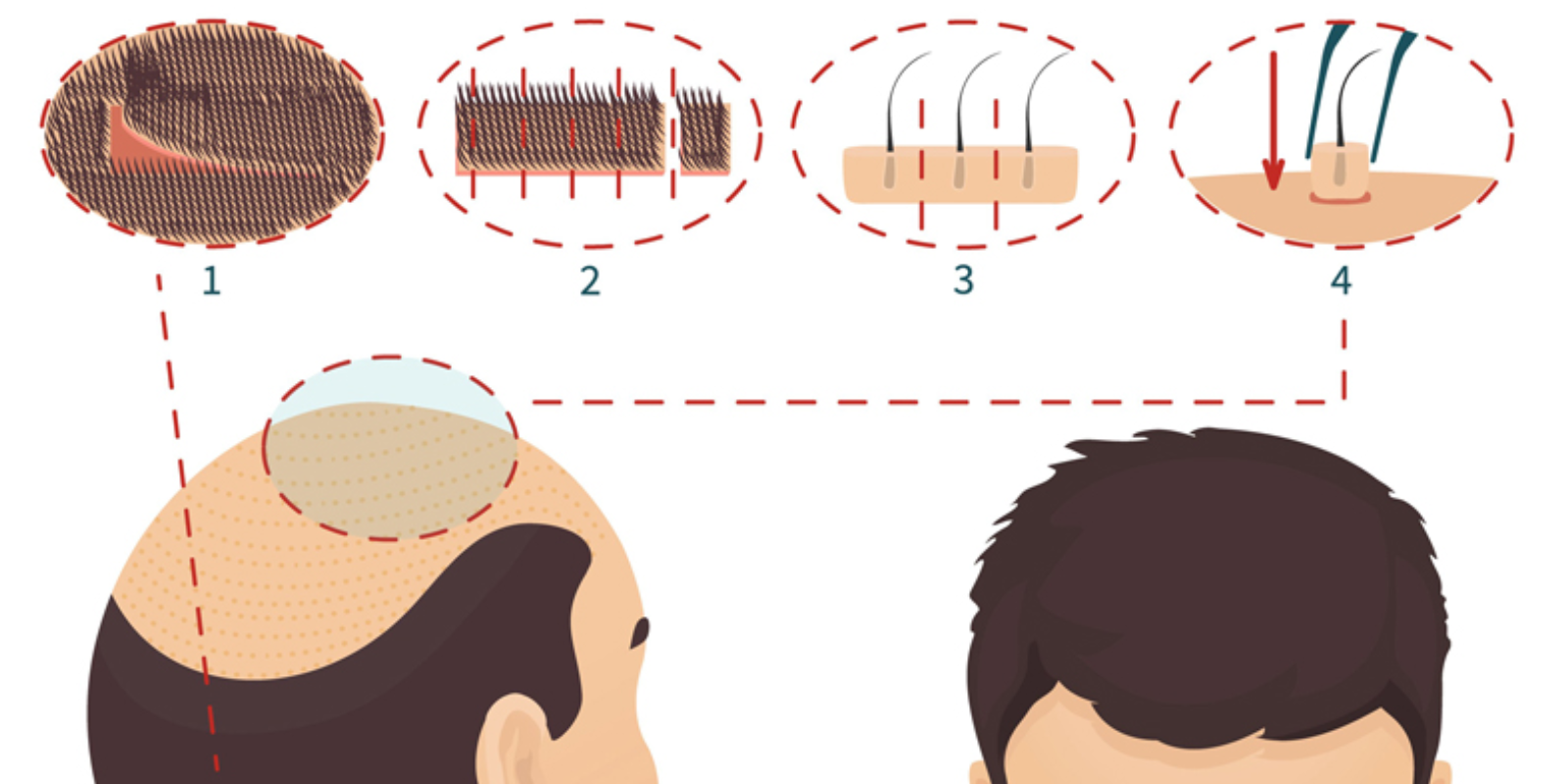 Cấy tóc là gì? Tìm hiểu chi tiết và đầy đủ trước khi thực hiện