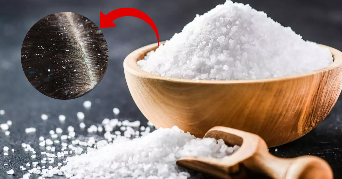 Cách trị gàu và ngứa da đầu bằng muối đơn giản tại nhà 