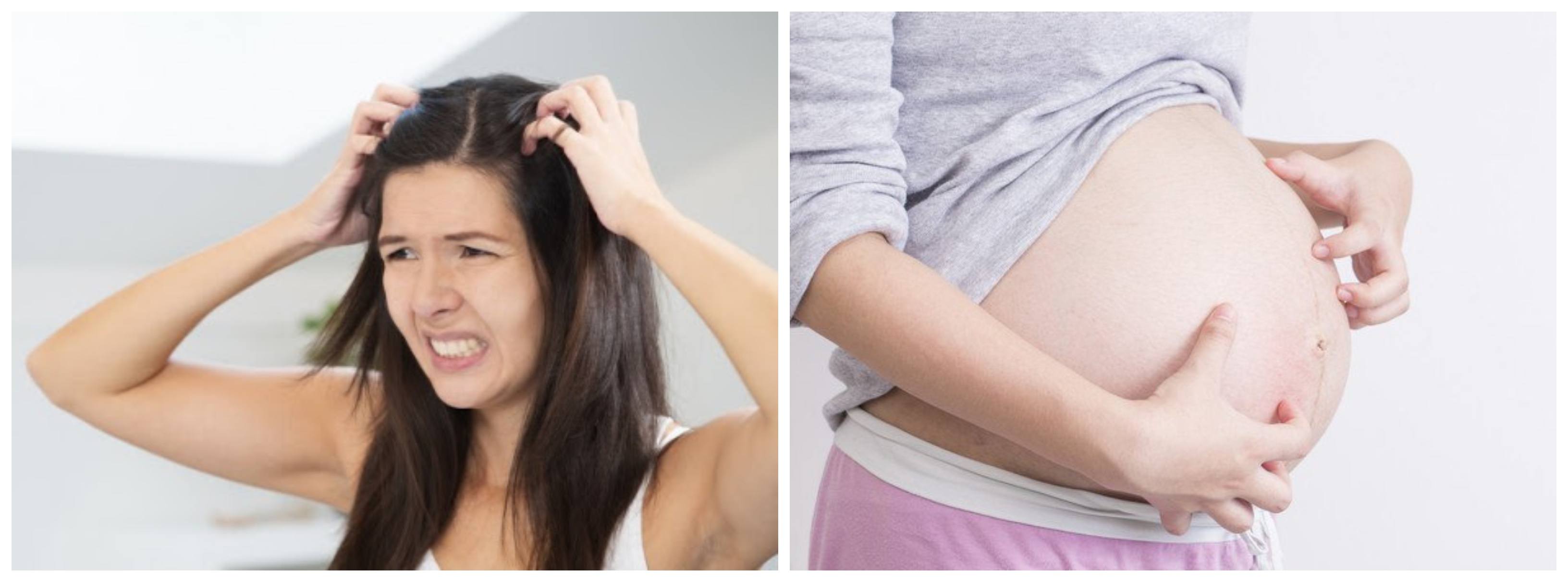 Nguyên nhân và cách điều trị ngứa da đầu khi mang thai