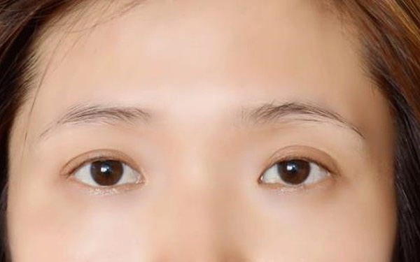 Rụng lông mày hậu Covid và các di chứng về lông-tóc-da khác  