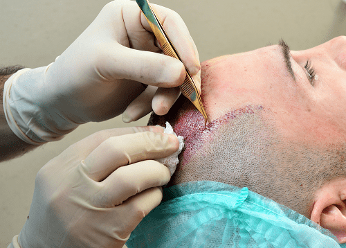 Tác dụng phụ của việc cấy tóc bạn phải biết