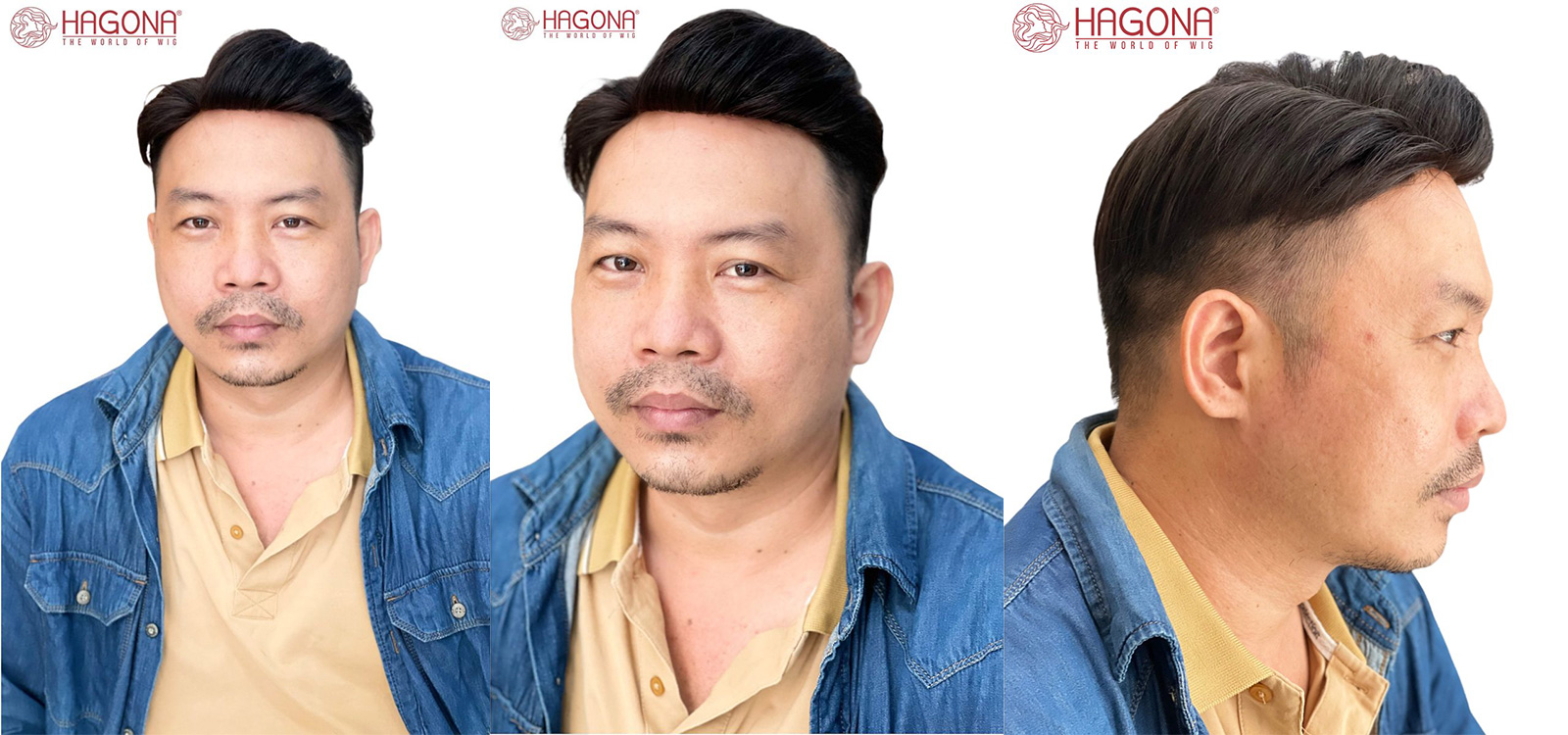 Miếng dán V3 tóc mái hói siêu da viền Poly màng lưới