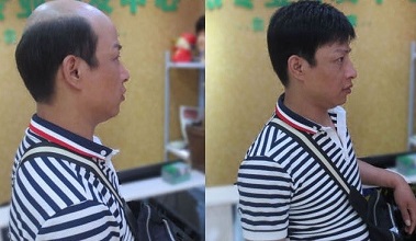 Lý do nên chọn tóc mái hói nam có da đầu