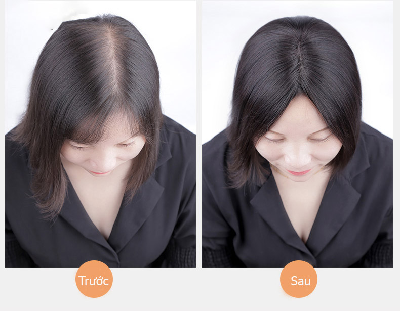 Tóc giả che hói đỉnh đầu nữ là gì? Đặc điểm và cách dùng của tóc giả che hói cho nữ