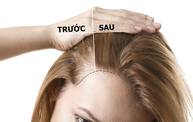 GIẢI ĐÁP Uống thuốc mọc tóc có hại không?