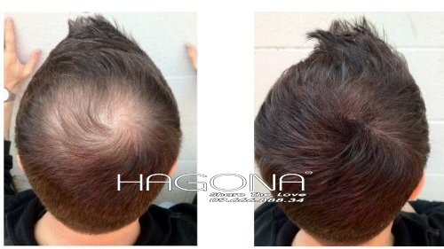 Khám phá chất liệu của các kiểu tóc dành cho nam đầu hói